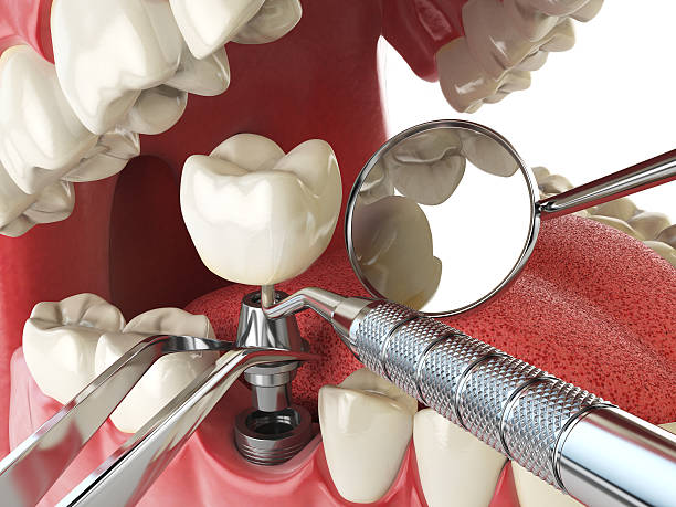 Best Emergency Cosmetic Dentistry (e.g., broken veneers) in Batavia, NY
